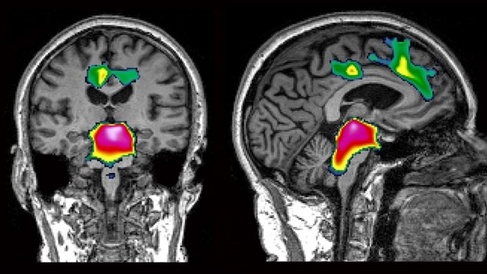 PSP Atrophy